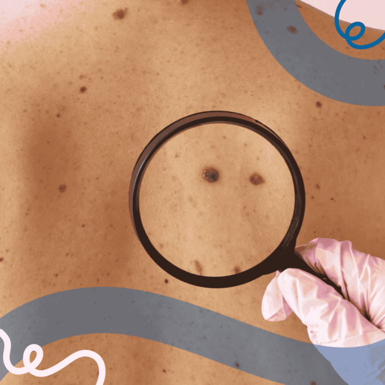 Valutazione dei nei sulla pelle della schiena per la prevenzione del melanoma.