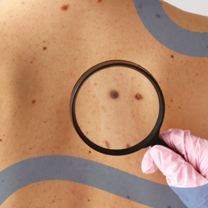 Valutazione dei nei sulla pelle della schiena per la prevenzione del melanoma.