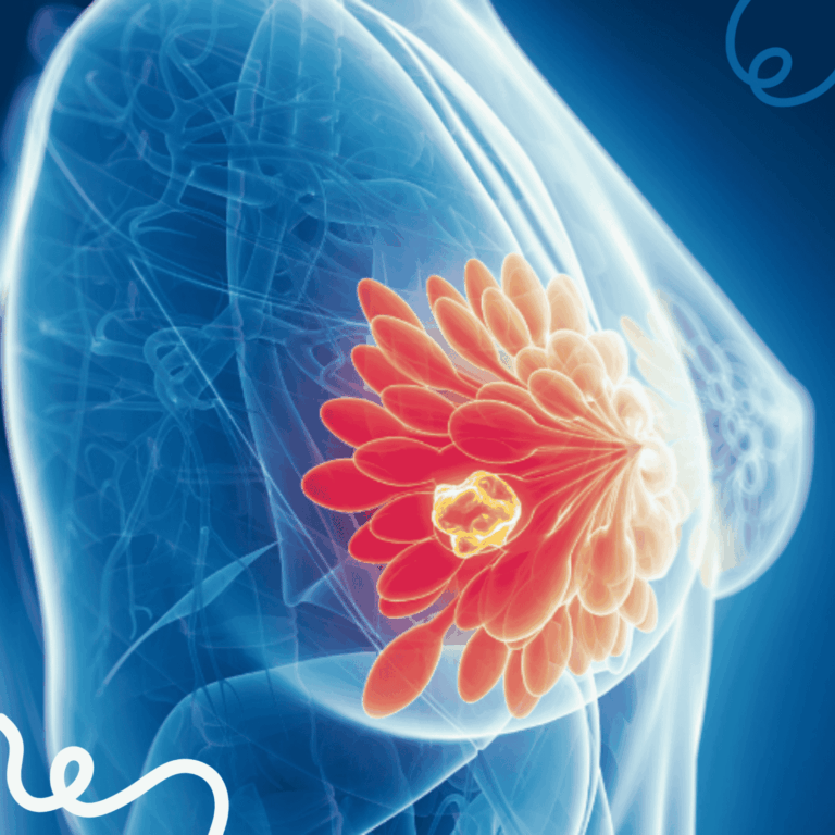 Rappresentazione 3D del tumore al seno con evidenza della massa tumorale e dei dotti mammari, usata per illustrare l’efficacia del farmaco elacestrant