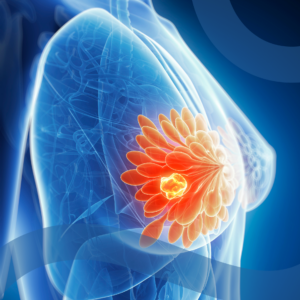Rappresentazione 3D del tumore al seno con evidenza della massa tumorale e dei dotti mammari, usata per illustrare l’efficacia del farmaco elacestrant