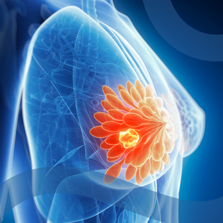 Rappresentazione 3D del tumore al seno con evidenza della massa tumorale e dei dotti mammari, usata per illustrare l’efficacia del farmaco elacestrant